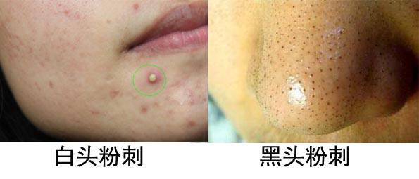 什么是痤瘡，什么是粉刺？痤瘡和粉刺有啥區(qū)別？