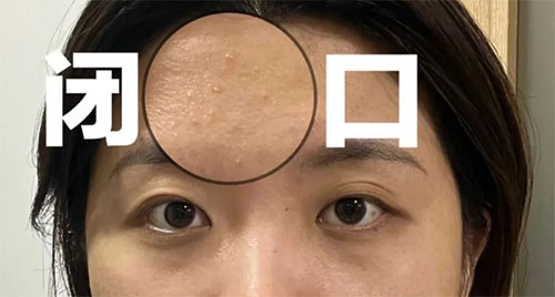 閉口粉刺形成的原因有哪些？